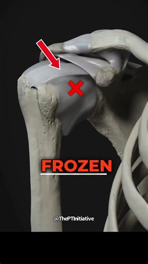 Dr. Adam McCluskey PT, DPT on Instagram: "🚨What Exactly is Frozen Shoulder and How to Fix It… - Adhesive Capsulitis (aka Frozen Shoulder) is a unique inflammatory process that attacks the shoulder capsule and ligaments. - Instead of clearing normally it leads to fibrosis that tighten the capsule, and some studies showing new nerve ending growth which can explain how painful it is. - It shows up as a loss of active and passive mobility in several planes of motion, with early and significant loss