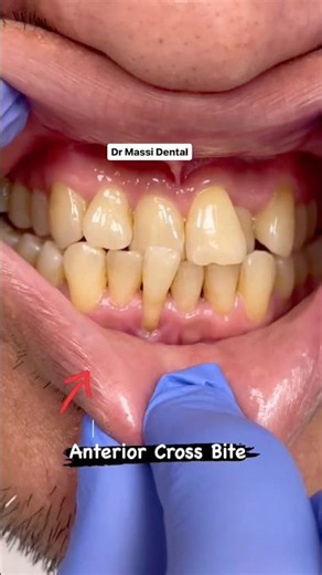 ANTERIOR CROSSBITE 😬🦷