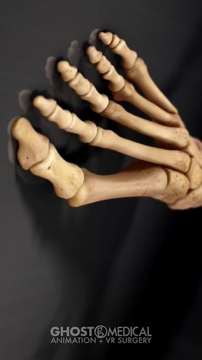 OsteoMed’s ExtremiLock™ Foot Plating System is designed to treat multiple reconstructive and trauma applications of the forefoot, midfoot and hindfoot. Dedicated instrumentation in this comprehensive system allows for multiple intraoperative options to accommodate surgical variation and patient anatomy. #footsurgery #orthopedics #processvideo #awareness #medicaldevice