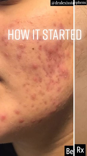 Revolutionize Acne Treatment with NeoClear