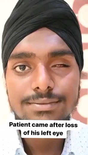 Dr Vikas Gupta, MDS (Ex PGI) | Chandigarh Facial Prosthetics | custom ocular prosthesis: matching artificial eye not only gives the natural look but also boost the self confidence. At chandigarh... | Instagram