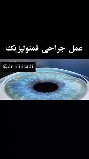 ‎دکتر علی ایزدی|جراح و متخصص چشم و لیزیک .فوق تخصص گلوکوم‎ on Instagram‎: "مراحل عمل جراحی برداشتن عینک ( فمتولیزیک) . . . #فمتواسمایل #فمتولیزیک #چشم_پزشک #اسمایل"‎