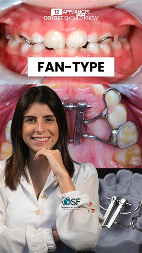 Dr. Rayane Pinto | The star of the second episode of our series is the Fan-Type, or butterfly expander. 🪭🦋 It’s one of the most commonly used expanders in... | Instagram