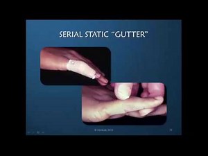 Obstinate PIP Joint: Part 8 of 12: PIP Static/Serial Static Extension Orthosis (Demonstration)