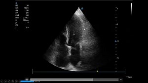 Diastolic dysfunction and increased LT atrial pressure diagnosis is a very important skill in the ICU. Understand new ASE diastolic guidlines in less than 5 minutes. Register in our recorded online course to learn so many critical care U/S tricks which will change your way of management and boost your ICU skills. We are continuously upgrading our courses., so you will expect new lectures to be added to your course from time to time. Attention please, now the complete Lower Limb arterial and veno