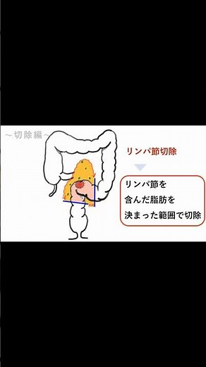 腹腔鏡下S状結腸切除の方法 ４