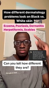 Here’s how Eczema, Psoriasis, Dermatitis Herpetiformis, and Scabies look on darker vs. lighter skin tones! #representationmatters #dermondarkerskin #medicine #healthcare #joelbervell #dermatology | Joel Bervell