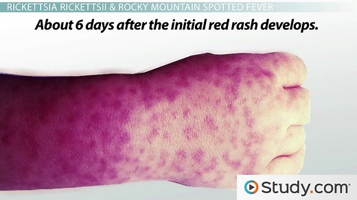 Spotted Fevers: Symptoms of Rickettsia Infections