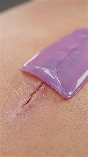 Doctors Can Close Cuts Without a Single Stitch 😳🩹