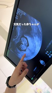 赤ちゃんの異変に気づく方法：心音・胎動・張りチェック