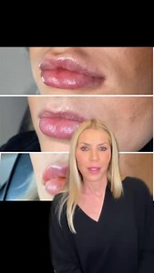 There’s something very important I want to discuss: filler “migration”. Filler doesn’t magically just move, it’s need some type of force to move it. Be sure to watch until the end to hear my full thoughts on this topic. | Jennifer Armstrong, MD