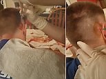 Not for the squeamish: Huge cyst popped at home by a nurse | Daily Mail Online