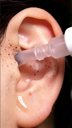 Extreme Ear Blackhead Vacuum | Satisfying ASMR Suction Sound #facials #blackheadcaique #skincare