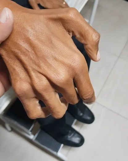 Disuse atrophy may affect: Sedentary lifestyle. Malnourishment No enough exercise. Can’t move your limbs due to a stroke or other conditions such as dermatomyositis. Age-related atrophy (sarcopenia). Diseases and other conditions that can affect these nerves include: Amyotrophic lateral sclerosis (ALS). Guillain-Barre syndrome. Carpal tunnel syndrome. Polio. Spinal cord injury. Multiple sclerosis. | Neurology