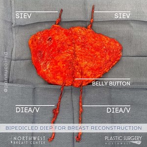 Multiple flap reconstruction for mastectomy defect