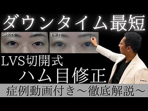 切るのにダウンタイムが最短！ハム目修正（睫毛上皮膚切除）の徹底解説：全切開二重の他院修正