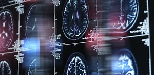 Alzheimer’s disease is partly genetic − studying the genes that delay decline in some may lead to treatments for all