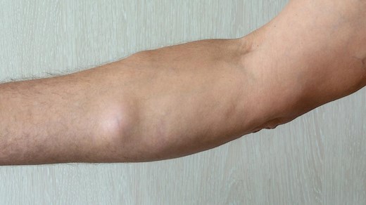 Lipom: Gutartige Fettgeschwulst oder bösartiger Tumor?