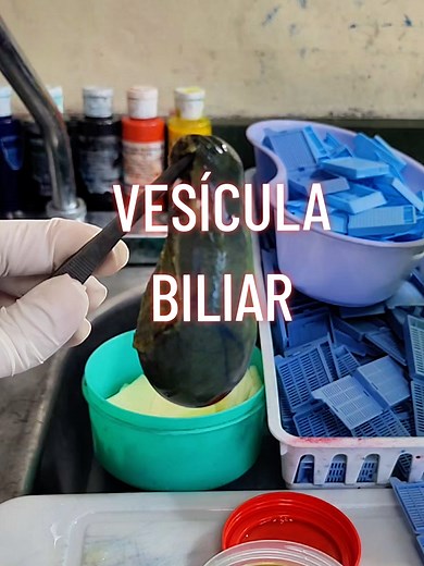 Vesícula Biliar: Información y Biopsias