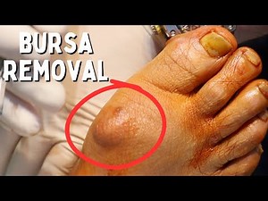 BURSA REMOVAL The Minimally Invasive Way!