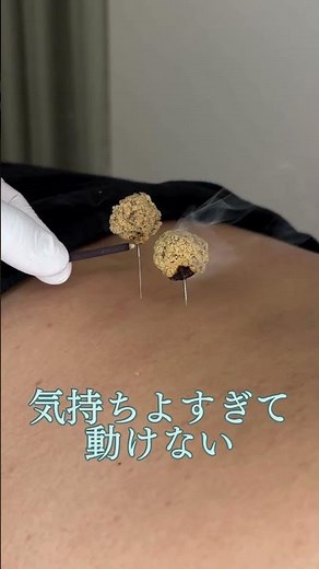 灸頭鍼とは？鍼とお灸を同時に行う施術を解説【望鍼灸院】