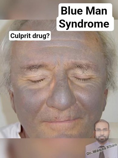Blue Man Syndrome #mbbs