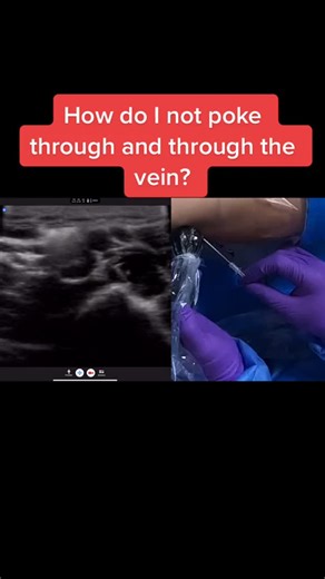 TheVascularGuy on Instagram: "patient - Why following the needle tip all the way down is important1.mp4"