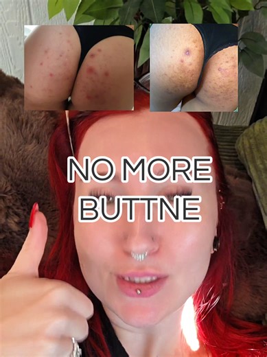 Combat Body Acne with This Must-Try Bodycare Trio