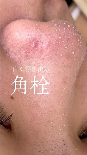 【角栓】たった1回で黒ずみを白く浮かせる最新美容 #韓国式3D毛穴洗浄 #毛穴