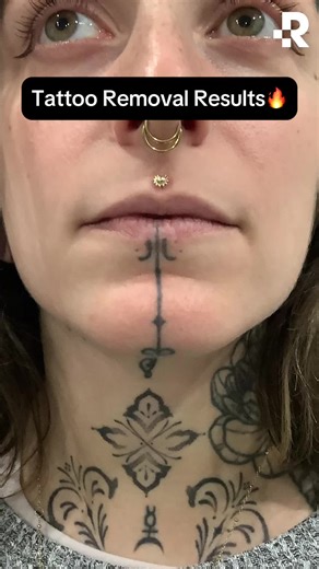 Expert Face Tattoo Removal Results and Options