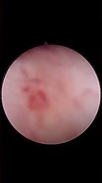 Removal of Endometrial Polyp