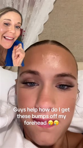 Dr. Abigail Waldman, MD FAAD on Instagram: "Do you have white heads or fungal acne? One clue that it could be fungal acne (aka pityrisporum folliculitis) is that the little white bumps on forehead and hairline don’t go away with typical acne treatments. Fungal acne is a result of skin yeast and responds to antifungal shampoos and creams. Follow if you have fungal acne. #fungalacne #acne #dermatologist"