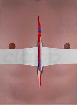 Open heart Bypass Surgery (3D Animation)