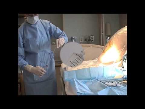 Gravity Flow Technique for Epidural Analgesia and Anesthesia