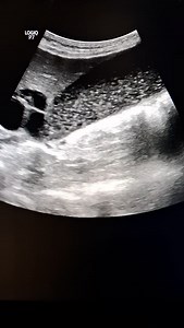 Obstructive jaundice #pancreaticcarcinoma #dr_wasi_ultrasound #abdominalultrasound #ultrasounds #medicaleducation | Ultrasound made easy