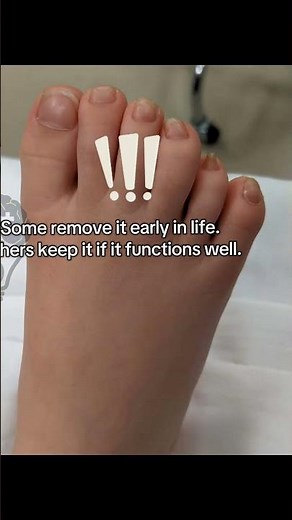 Why Are Some People Born With Extra Fingers? #genetics #rare #polydactyl