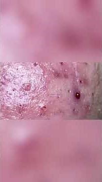 Satisfying Sebaceous Filament Extraction: Watch Blackheads Disappear! #shorts