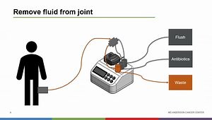 Anti-Bacterial, Lavage, Infusion and Aspiration System