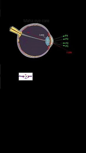 Purkinje image(reflections of objects formed by four refracting surfaces)#optometry#mahaeyecare#maha