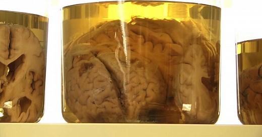 CTE research sheds light on patients' first symptoms