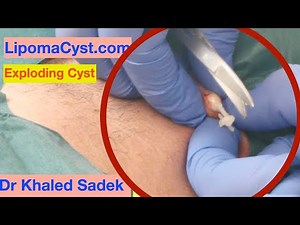 Dr Khaled Sadek. Neck Cyst Removal. LipomaCyst.com