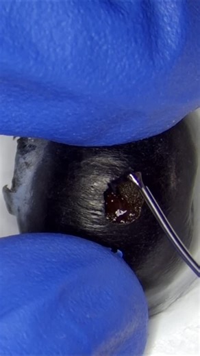 Atanas Bogoev on Instagram: "Ever seen eye surgery… on a blueberry? 🫐 It’s serious microsurgical training. Practicing capsulorhexis (a key step in cataract surgery) on fruit helps refine precision, control, and circular motion — skills every eye surgeon needs in the OR. I’m using MST capsulorhexis forceps @mst_eye to create a perfect flap — shear, tear, and steer. From synthetic domes to foil, I’ve tried it all — but nothing beats the delicate tension of blueberry skin. If you’re an aspiring op