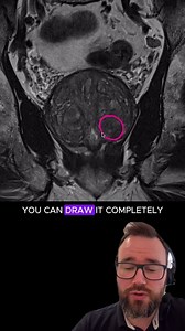 🚀 Level up your MRI reporting skills! Check out our video courses for more awesome teaching such as this by Joe Mullineux. 💻 Sign up at radiopaedia.org/courses and don't forget that if you live in one of the 125 low and middle income countries listed on our website, you can access the entire teaching library for free! | Radiopaedia.org