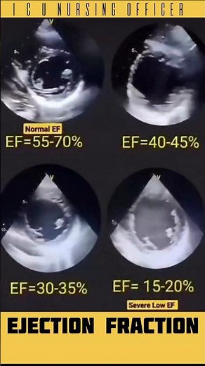 "How to Check EF? Echo Test Explained in Short" #EjectionFraction #HeartFailure #Cardiology #Echo