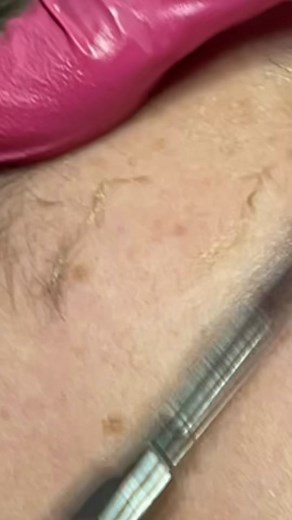 Dermaplaning Benefits and Frequency Explained