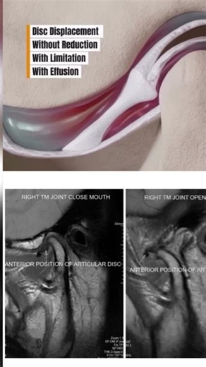 #tmjdisorder #internalderangement # disc displacement without reduction