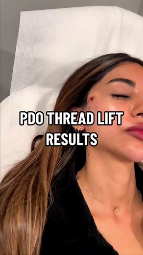 PDO Thread Lift: Non-Surgical Face Tightening Treatment
