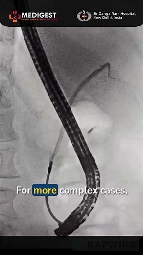 Endoscopic Retrieval of Migrated Biliary Stent | Soehendra Stent Retriever Technique . #explore