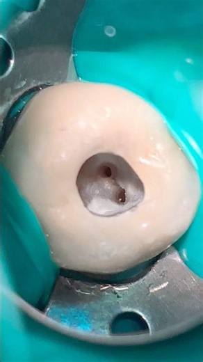 "4-Root Canal Maxillary Right First Molar (Crowned)" @ #RootsAdvancedEndodontics