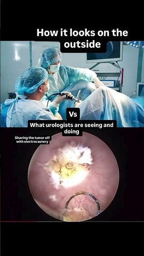 A transurethral resection of the bladder tumor (TURBT) till this date is my favorite procedure in